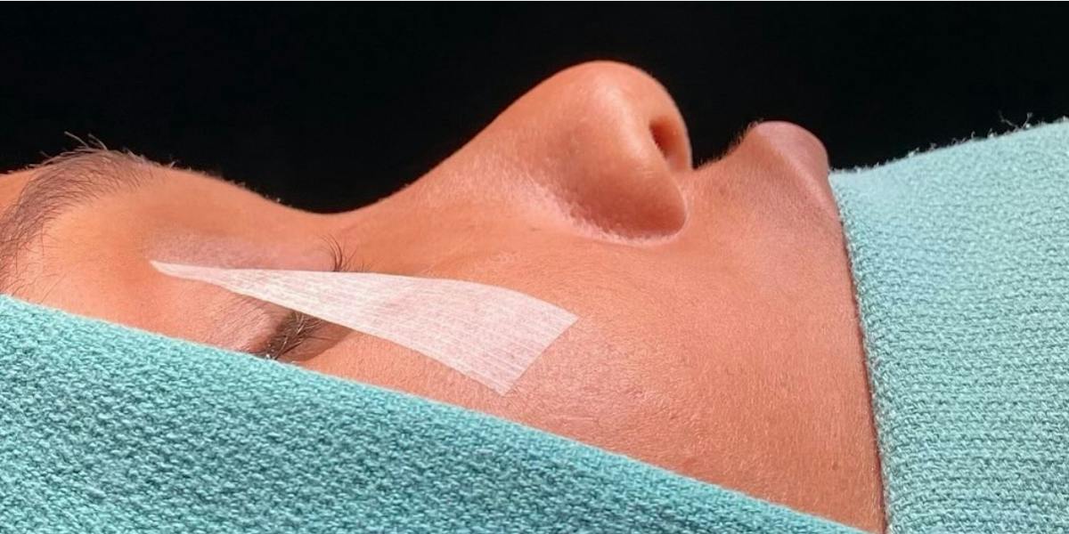 Rhinoplasty Before & After Gallery - Patient 331177 - Image 1