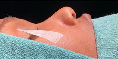 Rhinoplasty Before & After Gallery - Patient 331177 - Image 1