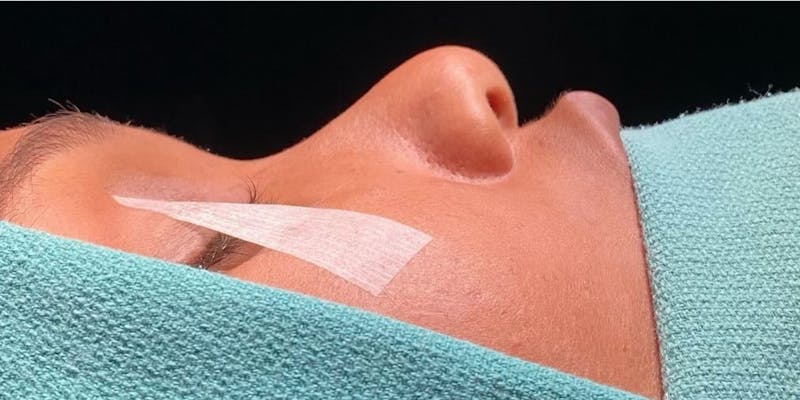 Rhinoplasty Before & After Gallery - Patient 331177 - Image 1