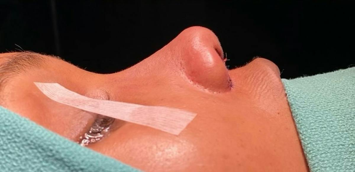 Rhinoplasty Before & After Gallery - Patient 331177 - Image 2