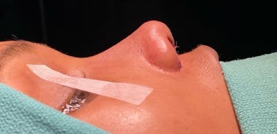 Rhinoplasty Before & After Gallery - Patient 331177 - Image 2