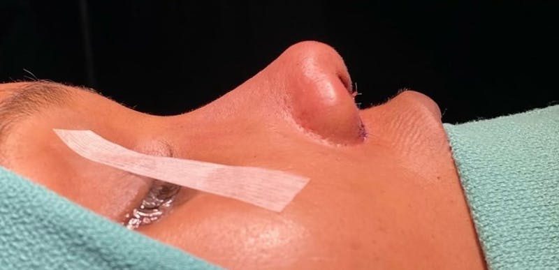 Rhinoplasty Before & After Gallery - Patient 331177 - Image 2