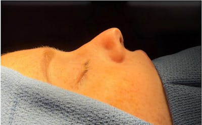 Rhinoplasty Before & After Gallery - Patient 273608 - Image 1
