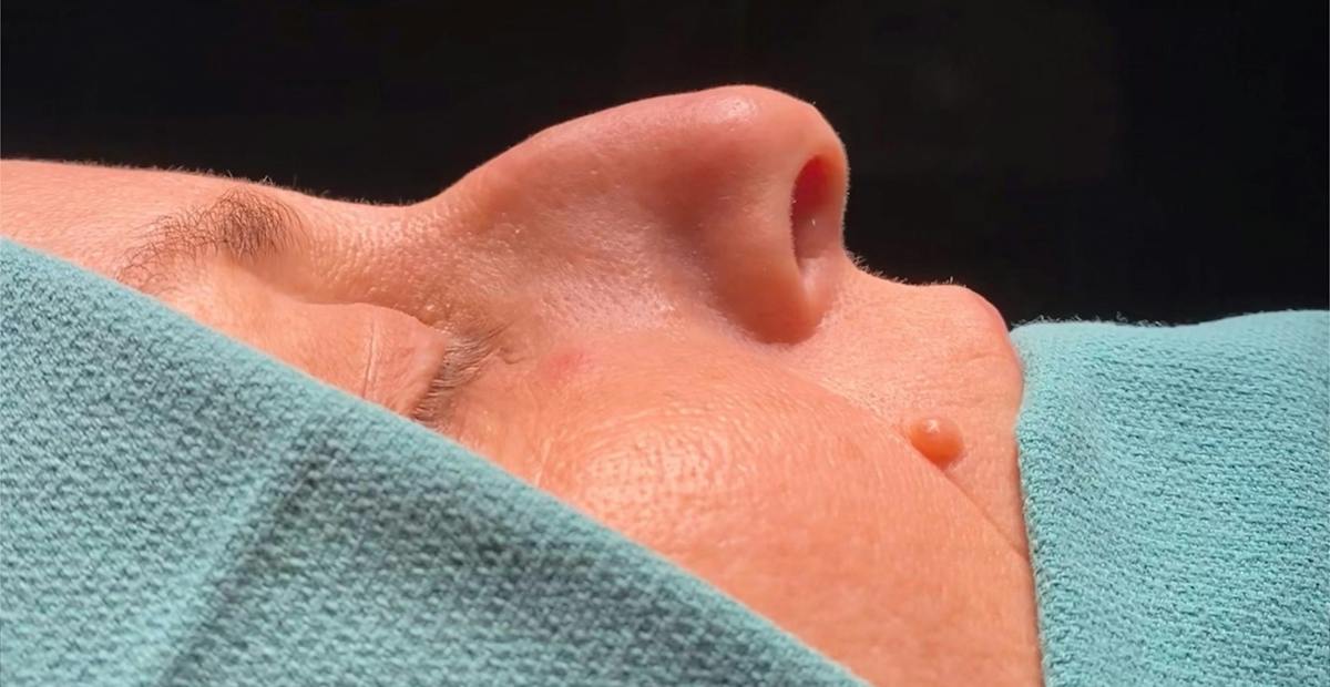 Rhinoplasty Before & After Gallery - Patient 103683 - Image 1