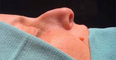 Functional Nasal Surgery Before & After Gallery - Patient 286380 - Image 1