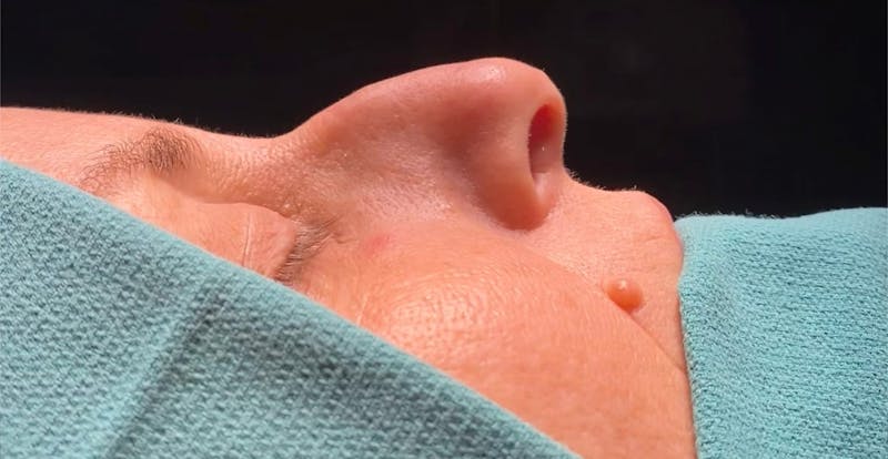 Rhinoplasty Before & After Gallery - Patient 103683 - Image 1