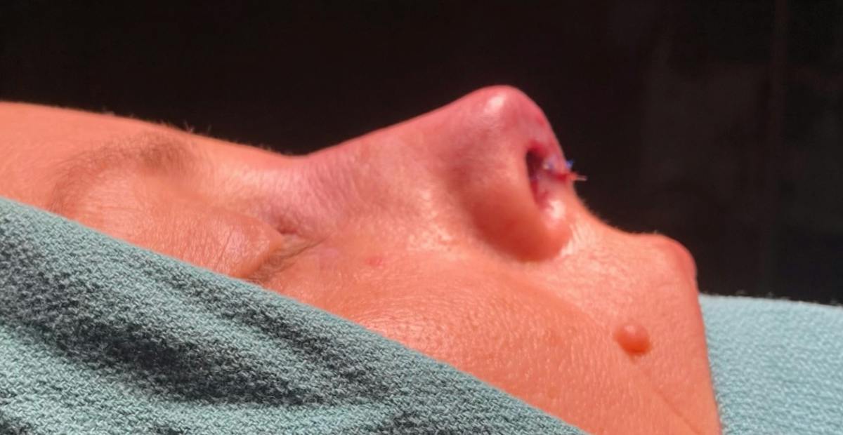 Rhinoplasty Before & After Gallery - Patient 103683 - Image 2