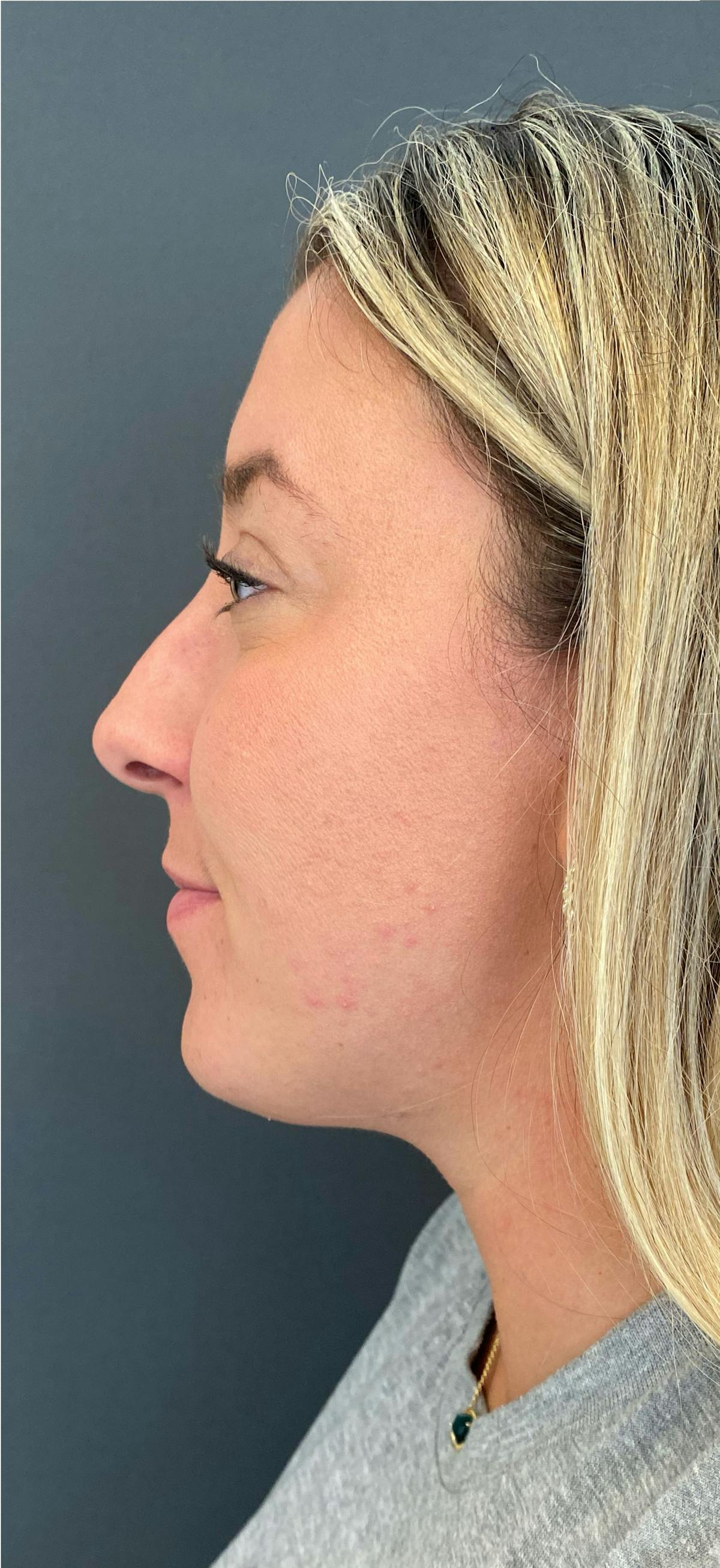 Rhinoplasty Before & After Gallery - Patient 195694 - Image 1