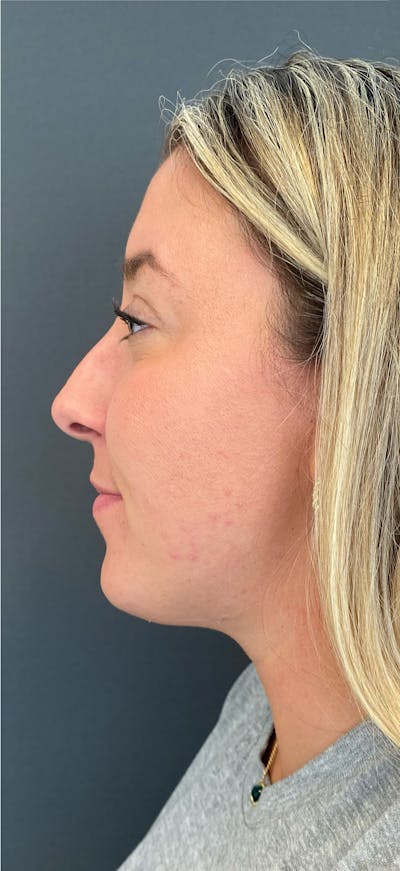 Revision Rhinoplasty Before & After Gallery - Patient 125063 - Image 1