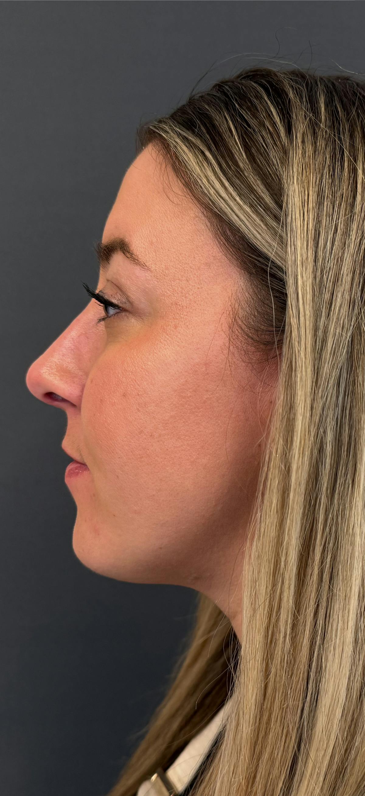 Rhinoplasty Before & After Gallery - Patient 195694 - Image 2