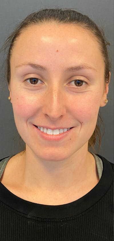 Rhinoplasty Before & After Gallery - Patient 245668 - Image 1