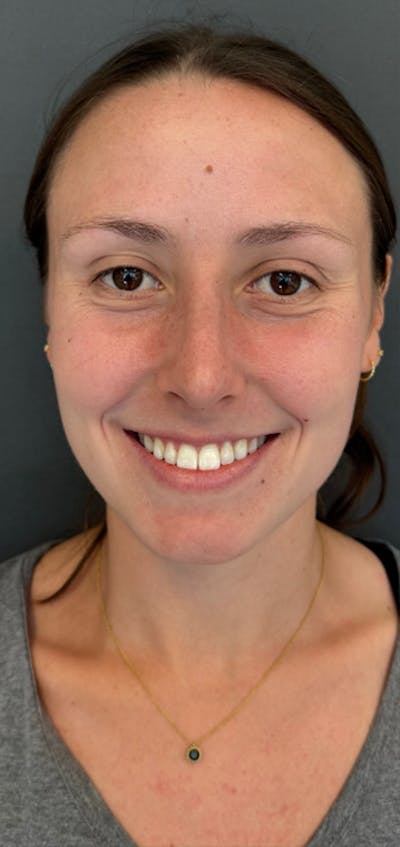 Rhinoplasty Before & After Gallery - Patient 245668 - Image 2