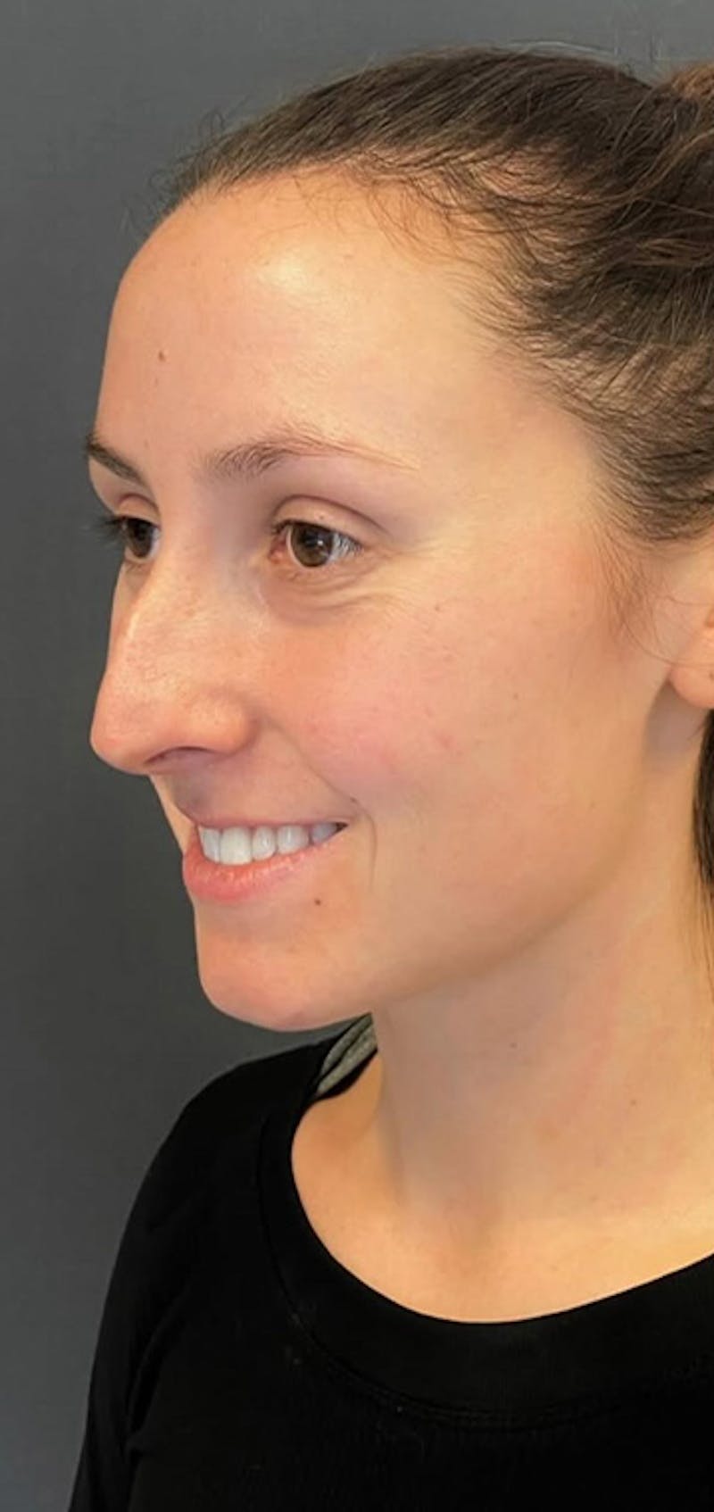 Rhinoplasty Before & After Gallery - Patient 245668 - Image 3