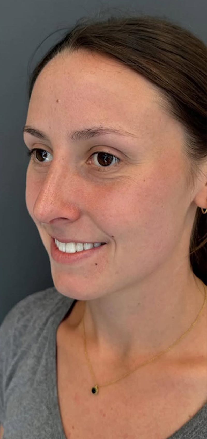 Rhinoplasty Before & After Gallery - Patient 245668 - Image 4