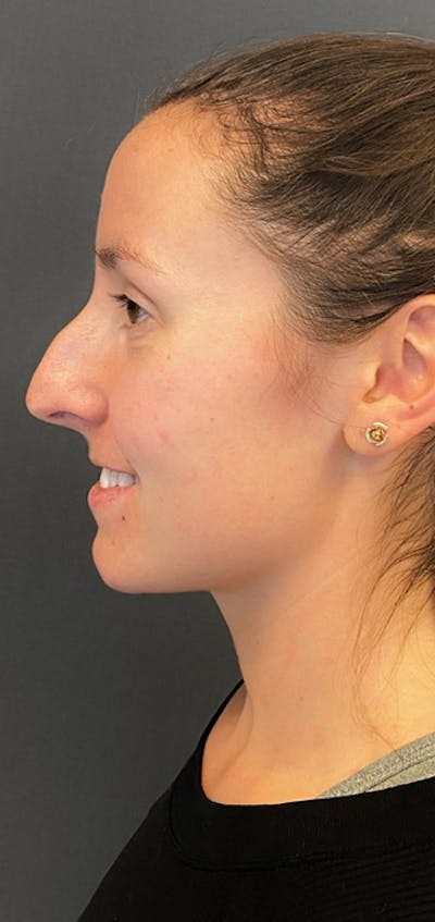 Rhinoplasty Before & After Gallery - Patient 245668 - Image 1
