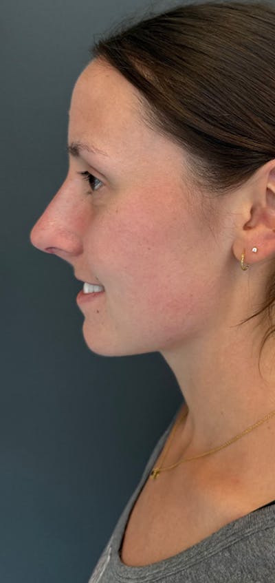Rhinoplasty Before & After Gallery - Patient 245668 - Image 2