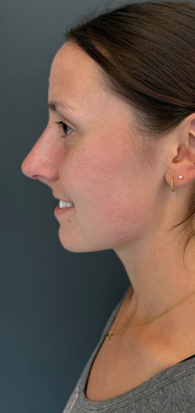 Rhinoplasty Before & After Gallery - Patient 245668 - Image 6