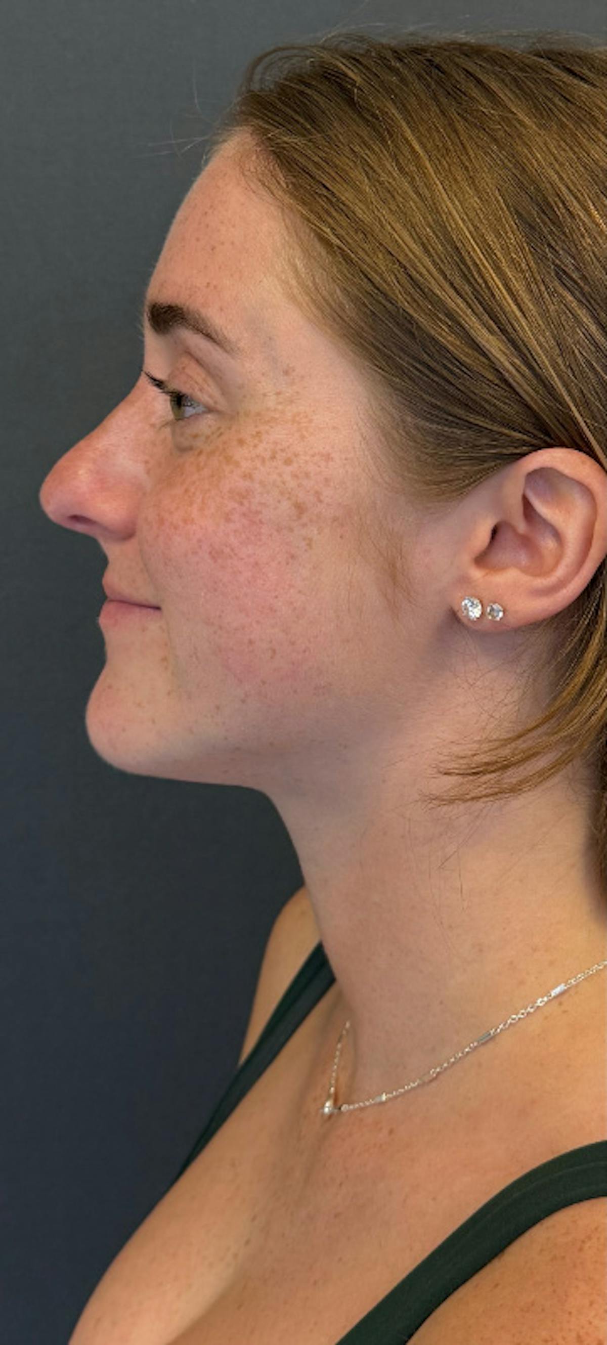 Rhinoplasty Before & After Gallery - Patient 423317 - Image 1