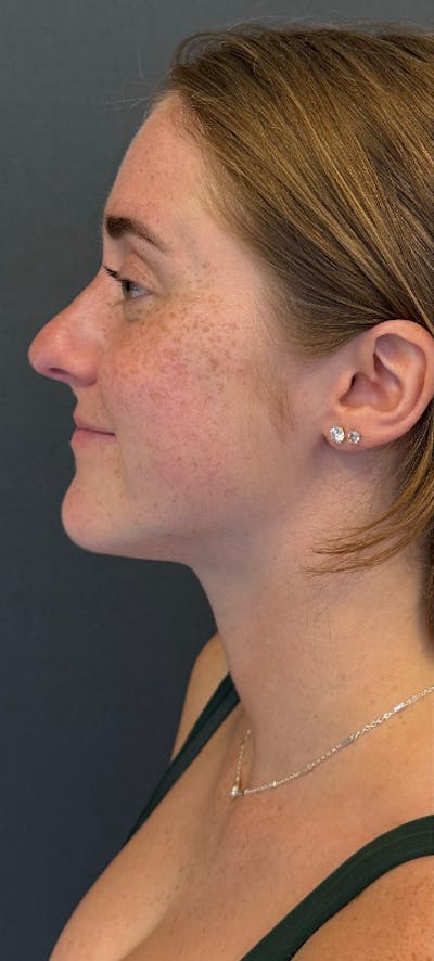 Revision Rhinoplasty Before & After Gallery - Patient 125072 - Image 1
