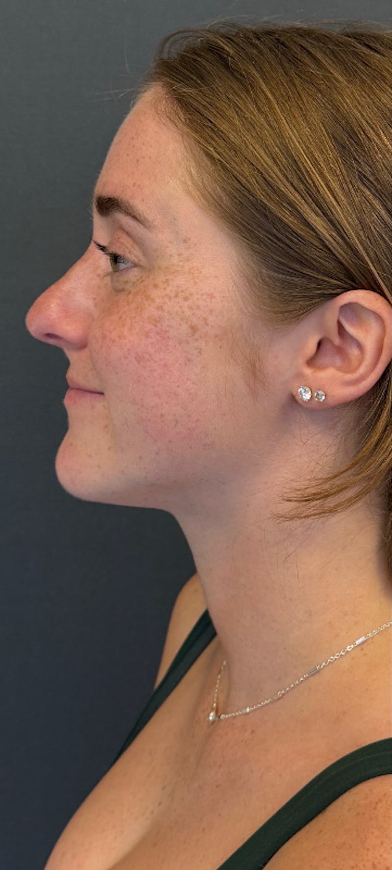 Revision Rhinoplasty Before & After Gallery - Patient 125072 - Image 1