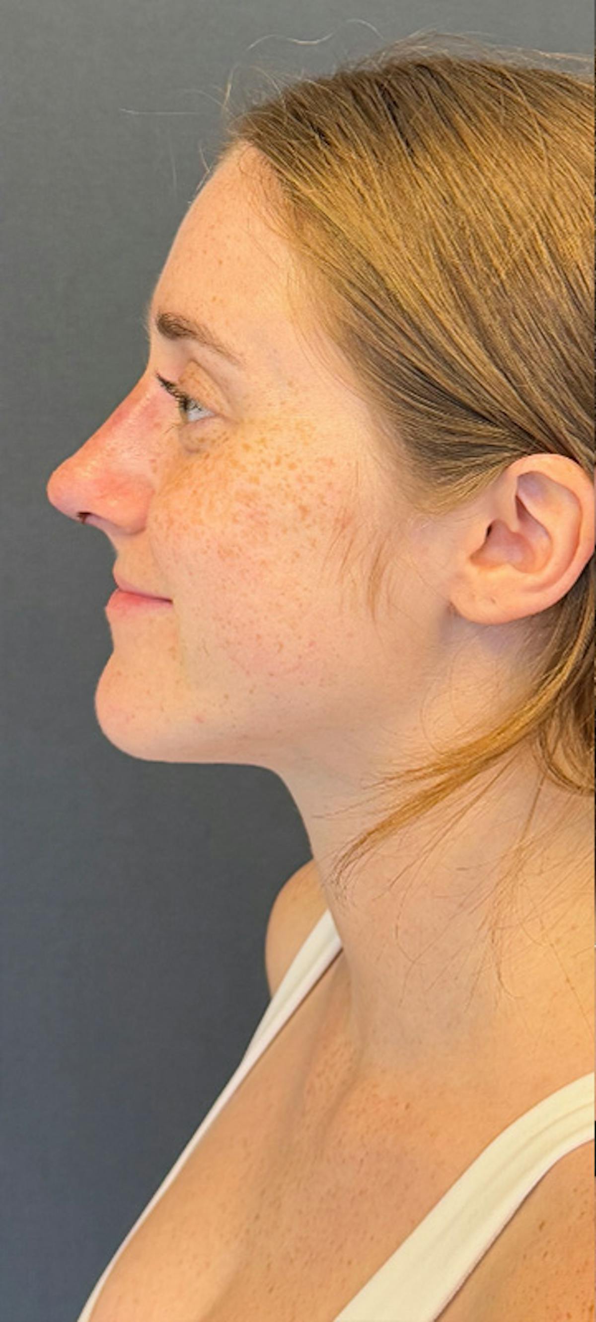 Rhinoplasty Before & After Gallery - Patient 423317 - Image 2