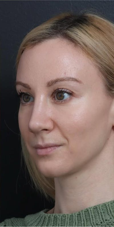 Revision Rhinoplasty Before & After Gallery - Patient 277382 - Image 2