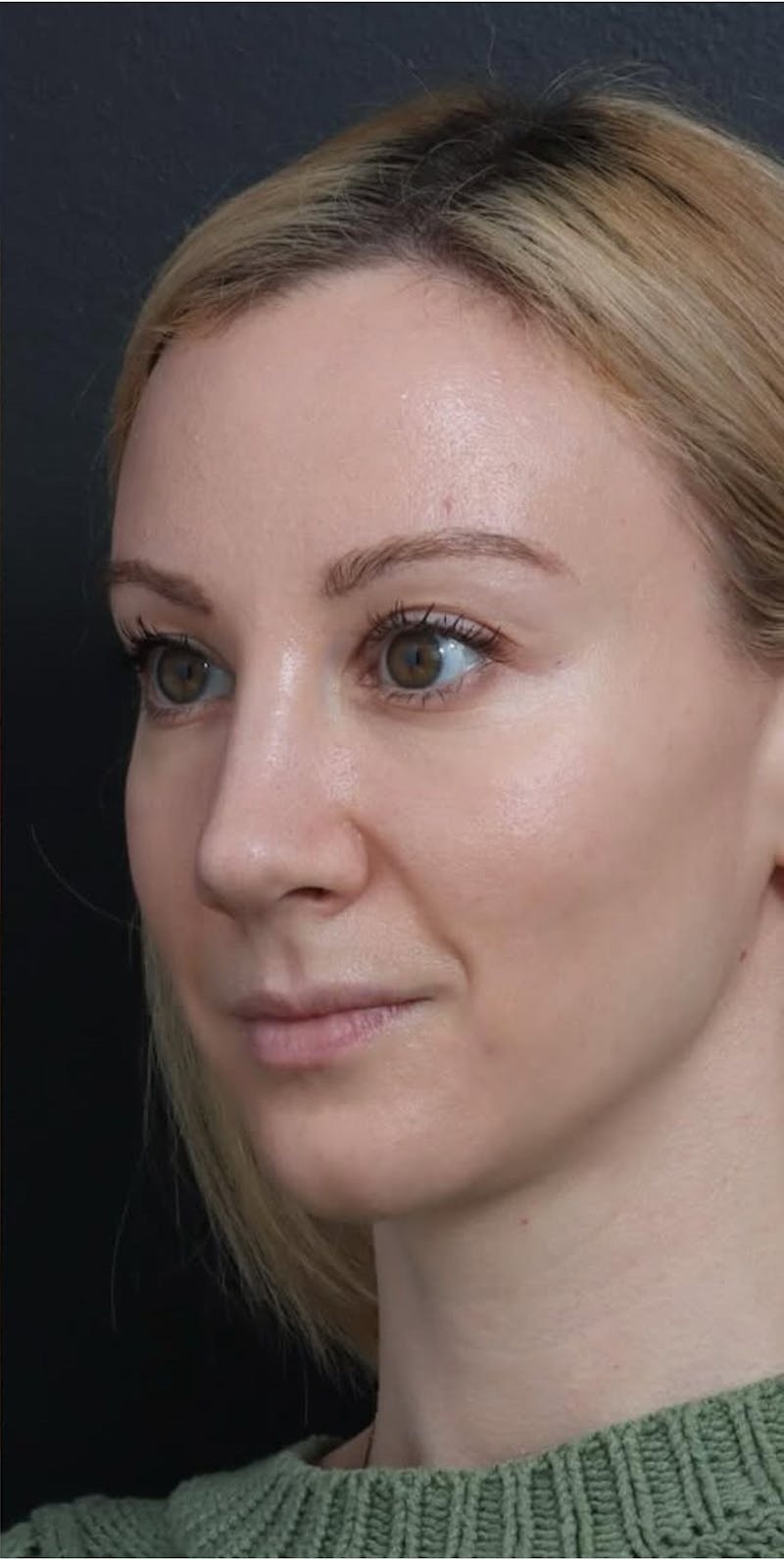 Revision Rhinoplasty Before & After Gallery - Patient 277382 - Image 2