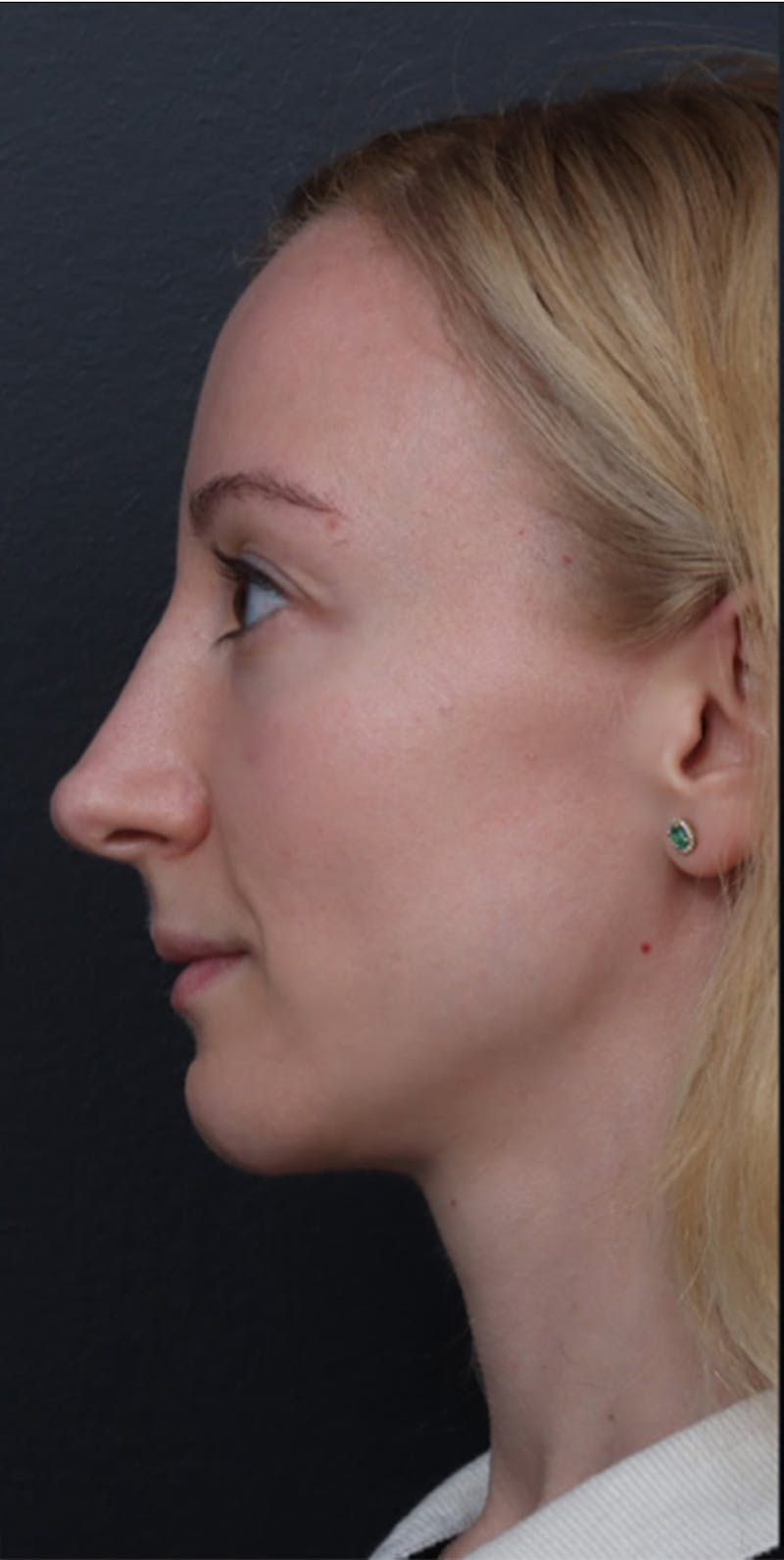 Revision Rhinoplasty Before & After Gallery - Patient 277382 - Image 3