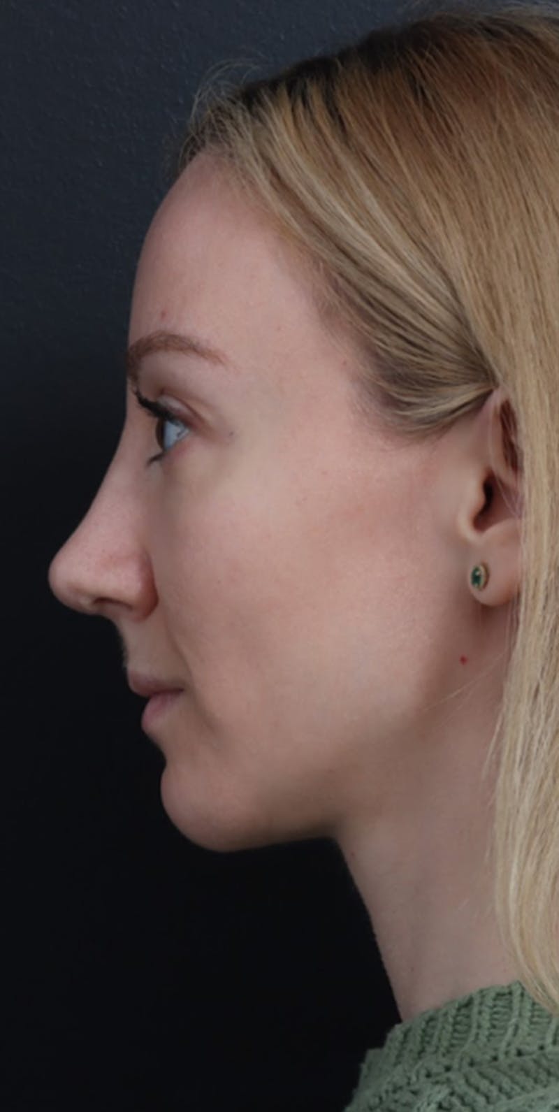 Revision Rhinoplasty Before & After Gallery - Patient 277382 - Image 4