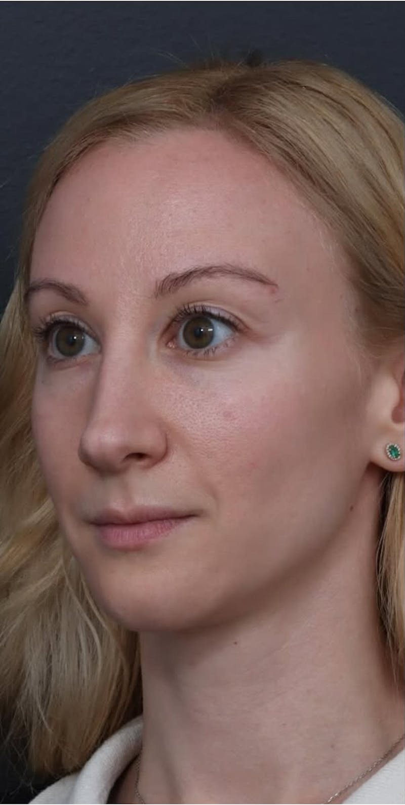 Revision Rhinoplasty Before & After Gallery - Patient 277382 - Image 1