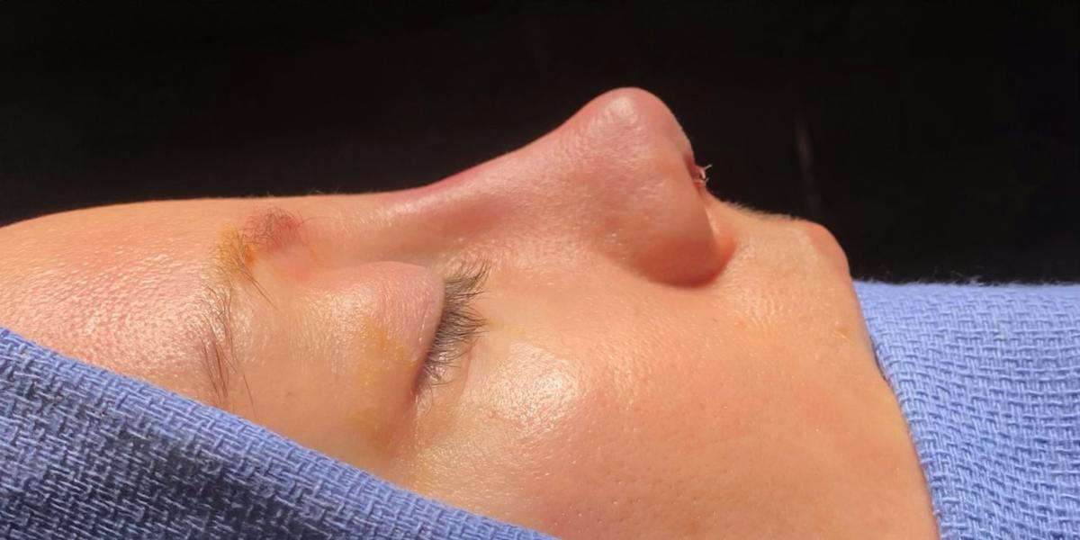 Revision Rhinoplasty Before & After Gallery - Patient 181228 - Image 2