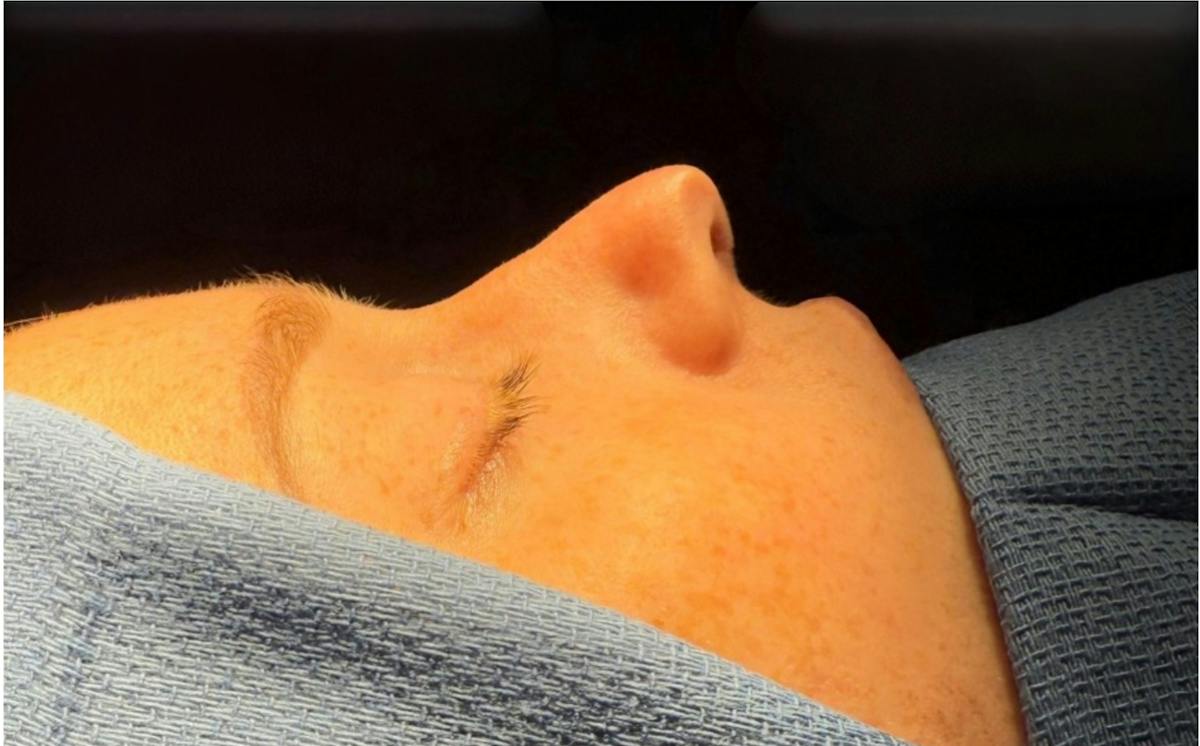 Revision Rhinoplasty Before & After Gallery - Patient 358597 - Image 1