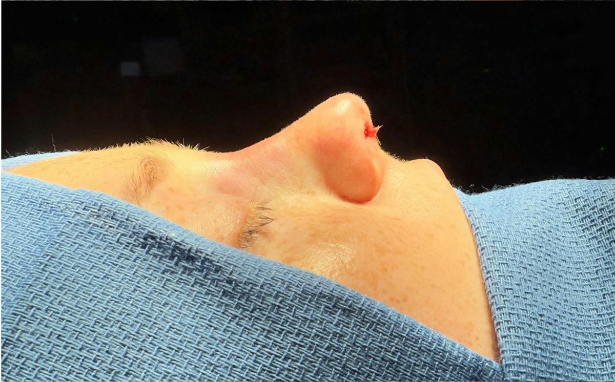 Revision Rhinoplasty Before & After Gallery - Patient 358597 - Image 2