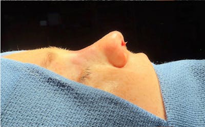 Revision Rhinoplasty Before & After Gallery - Patient 358597 - Image 2