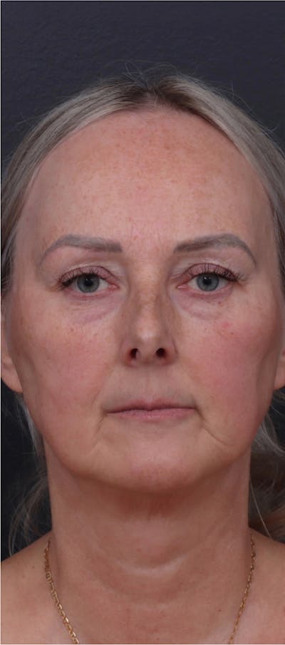 Facelift Before & After Gallery - Patient 229419 - Image 1