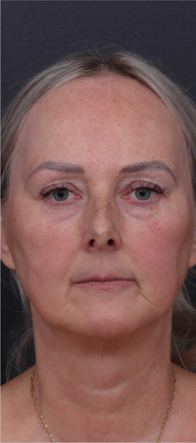 Facelift Before & After Gallery - Patient 229419 - Image 1