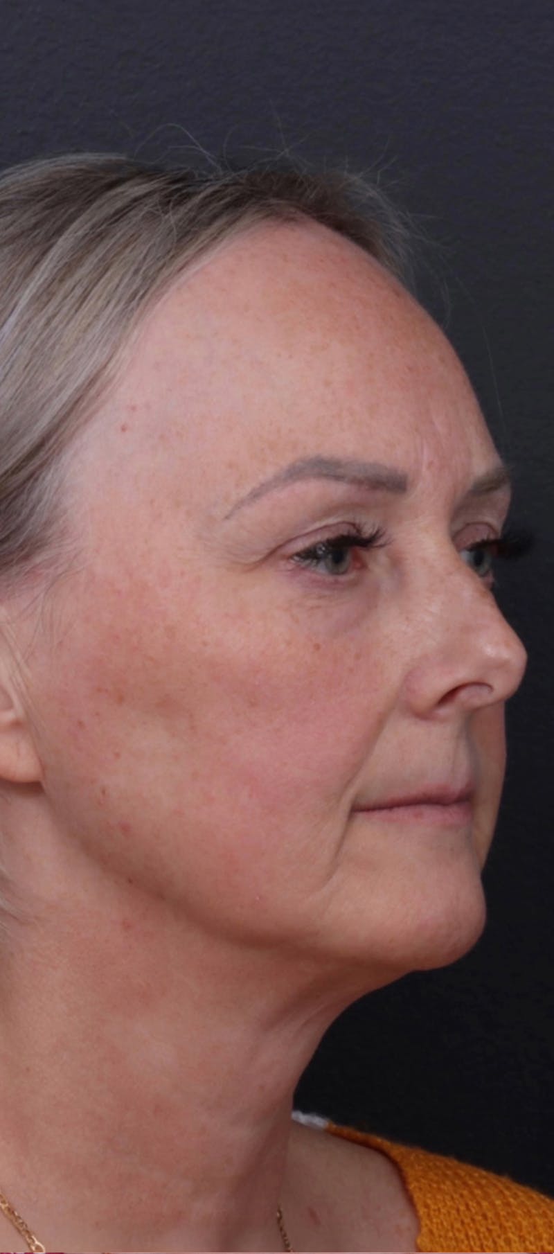 Facelift Before & After Gallery - Patient 229419 - Image 3