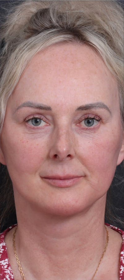 Facelift Before & After Gallery - Patient 229419 - Image 2
