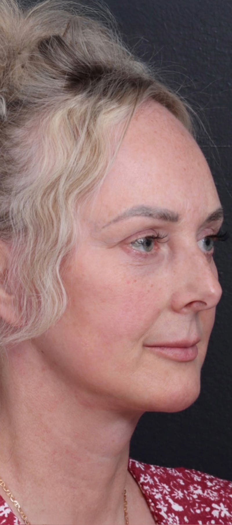 Facelift Before & After Gallery - Patient 229419 - Image 4