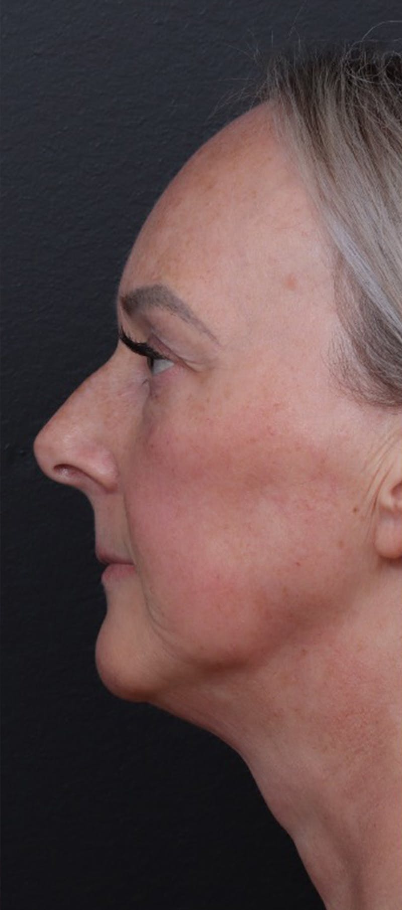 Facelift Before & After Gallery - Patient 229419 - Image 5
