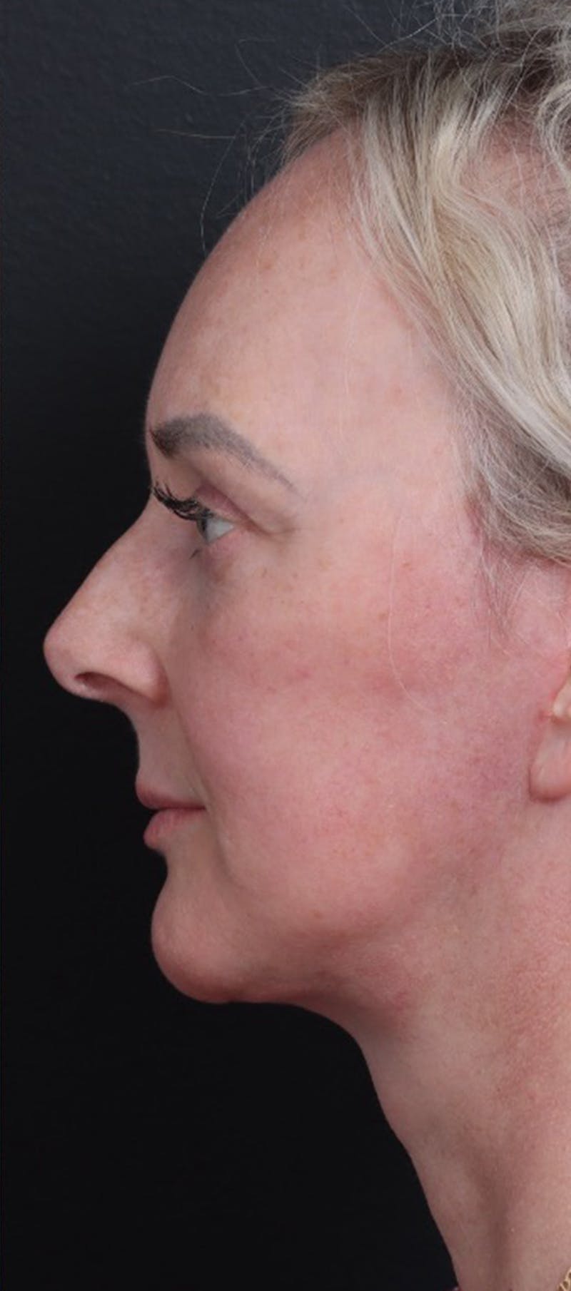 Facelift Before & After Gallery - Patient 229419 - Image 6
