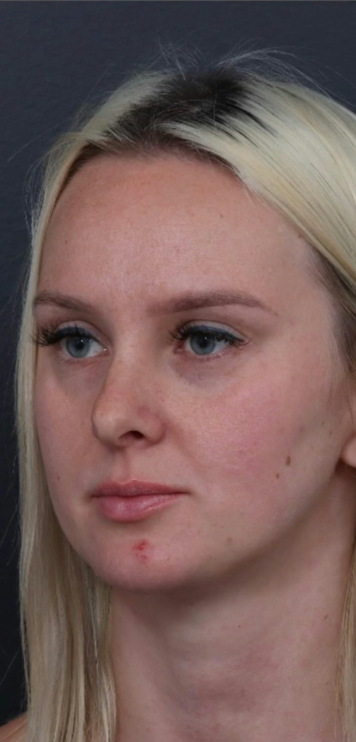 Dermal Filler Before & After Gallery - Patient 424732 - Image 1