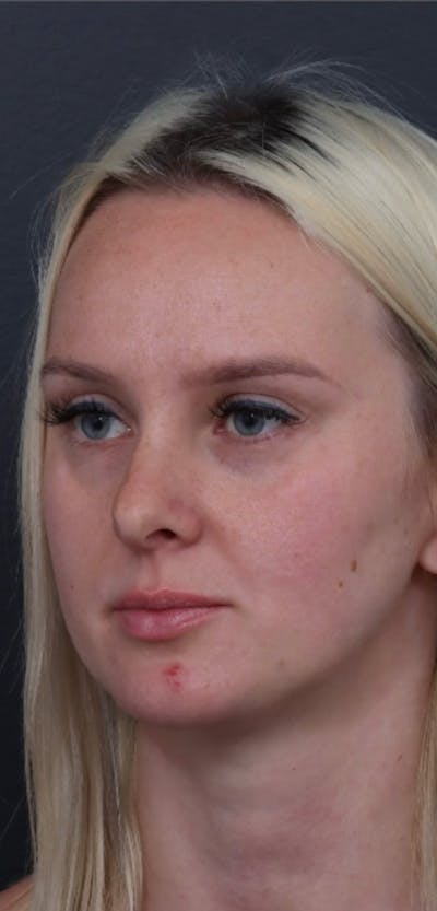 Dermal Filler Before & After Gallery - Patient 424732 - Image 1