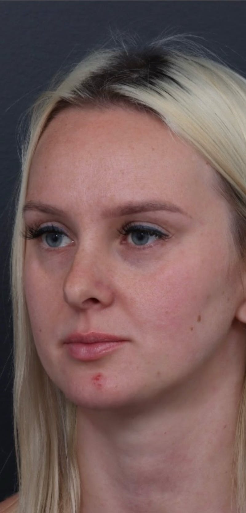 Dermal Filler Before & After Gallery - Patient 424732 - Image 1