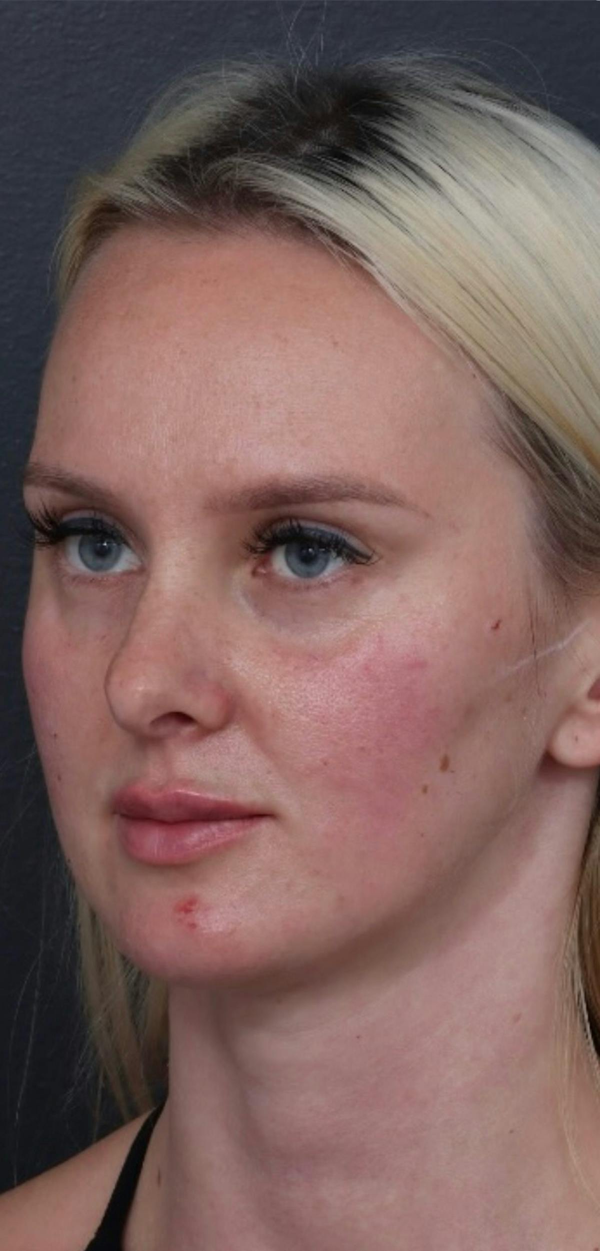 Dermal Filler Before & After Gallery - Patient 424732 - Image 2