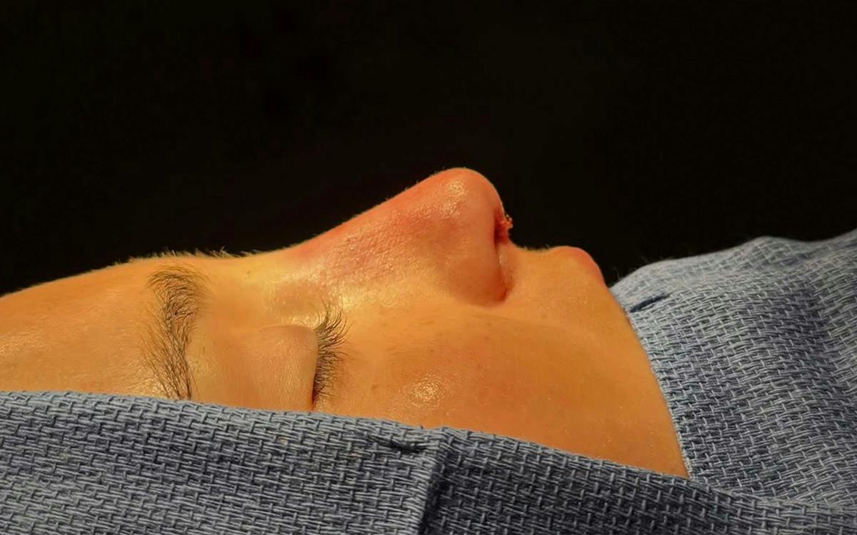 Functional Nasal Surgery Before & After Gallery - Patient 407477 - Image 2