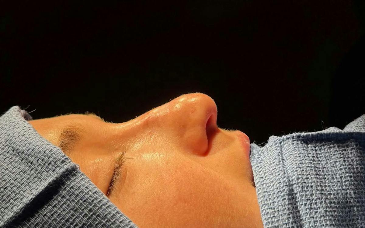 Functional Nasal Surgery Before & After Gallery - Patient 407477 - Image 1