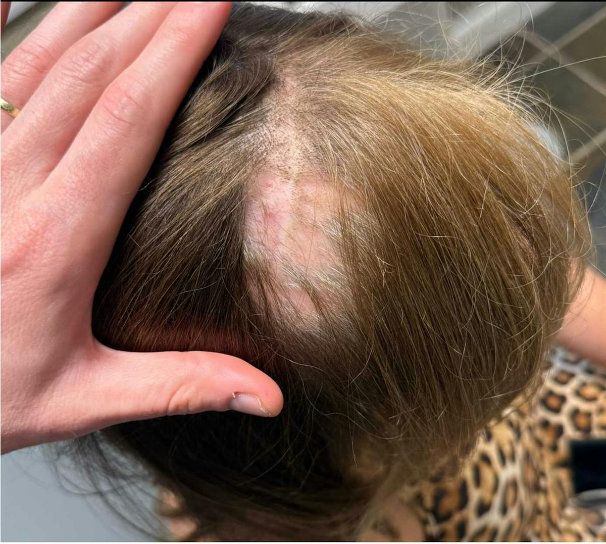 Hair Restoration Before & After Gallery - Patient 550255 - Image 1