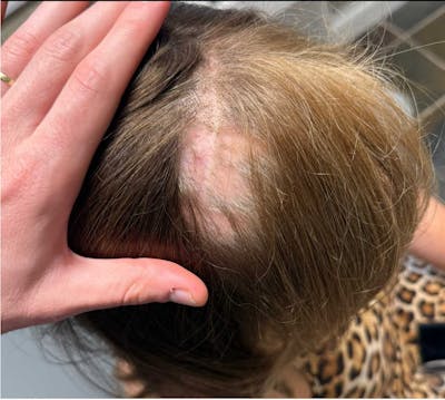 Hair Restoration Before & After Gallery - Patient 550255 - Image 1