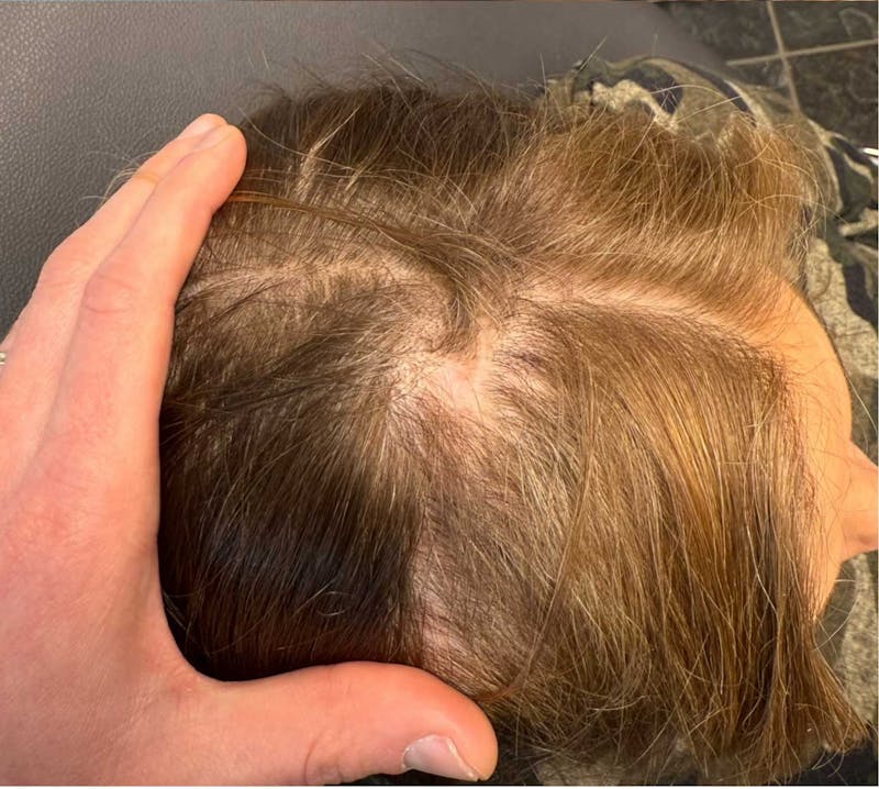 Hair Restoration Before & After Gallery - Patient 550255 - Image 2